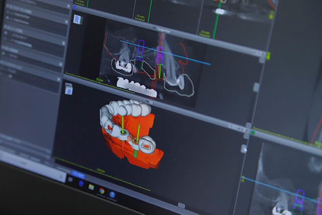 ストローマン3Dインプラントガイドシステム