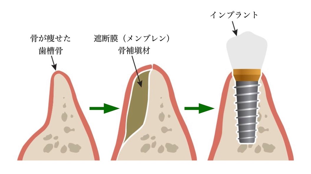 GBR (骨誘導再生法)