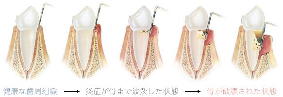 歯周病とは
