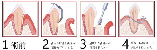 切除療法