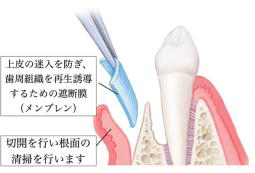 メンブレン（コラーゲン膜）による歯肉の誘導