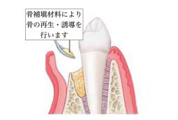 骨補填材による再生