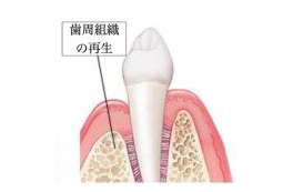 歯周組織の再生を確認