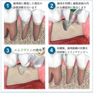 エムドゲインを用いた歯周組織再生療法